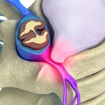 spinal decompression
